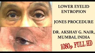 Entropion Repair Surgery Simplified  - Jones Procedure - Dr. Akshay Nair, Mumbai India (Full HD)