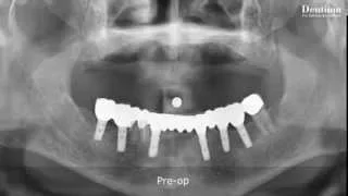 Practical dental implant with Dentium Implant