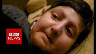 'My life without skin' - BBC News
