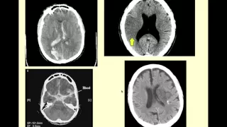 Stroke Syndromes - CRASH! Medical Review Series