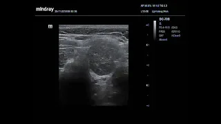 Видеозапись УЗИ - Отсутствие перешейка щитовидной железы на фоне АИТ