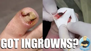 EXTREMELY DEEP AND INFECTED INGROWN TOENAILS ***100% CRINGE WORTHY***