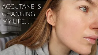 2 MONTH ACCUTANE JOURNEY UPDATE FOR MILD ACNE | SIDE EFFECTS & SKINCARE ROUTINE