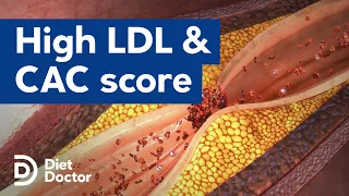 High LDL has low risk of coronary calcium