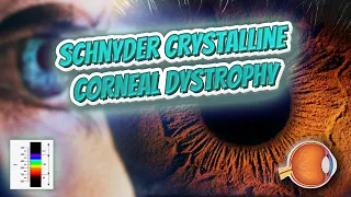 Schnyder crystalline corneal dystrophy (Your EYEBALLS) 👁️👁️💉😳💊🔊💯✅