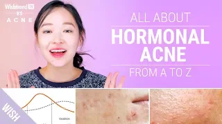 How to Cure Hormonal Acne : Lifestyle & Skincare Tips! | Wishtrend TV VS ACNE