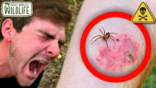 BROWN RECLUSE BITE! What Happens?