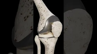 Total Knee Replacement