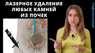 Лазерное дробление (литотрипсия) камней в почках, мочеточниках, мочевом пузыре | Mednavigator.ru