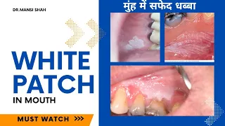 Is this cancer ? White Patch stain daag in Mouth or rough white skin due to Tabacco smoking