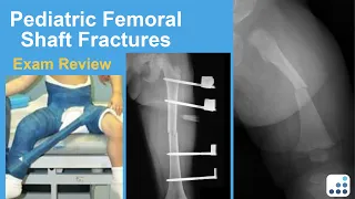 Pediatric Femoral Shaft Fractures Exam Review - Eric Shirley, MD