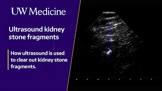 Ultrasound device gives kidney stone patients new options