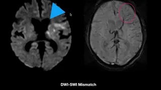 Diffusion- Susceptibility Mismatch in Stroke