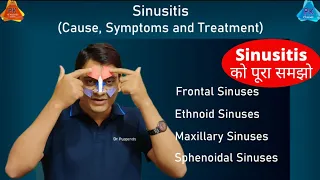 Sinusitis on Sinuses - Types and Treatment (By Dr. Puspendra)