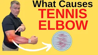 What Causes Tennis Elbow (Lateral Epicondylitis)? 1/9