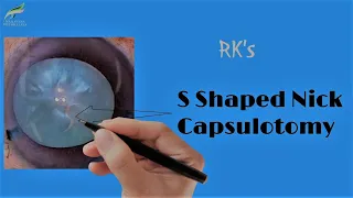 "RK's S shaped Nick Capsulotomy" - Intumescent Mature Cataract