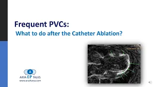 Risk Stratification after Catheter Ablation of Frequent PVC.