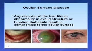 Introduction to Scleral Lenses