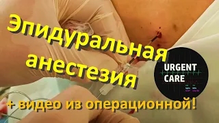 Эпидуральная анестезия. Лекция + видео из операционной!