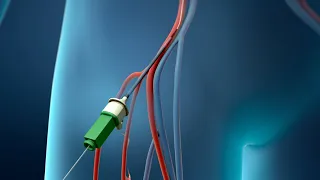 Coronary Angioplasty (Femoral Access)