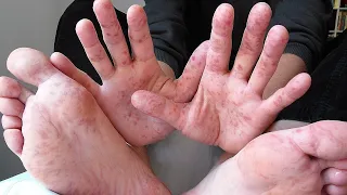 Энтеровирусная пузырчатка полости рта и конечностей (hand-foot-mouth disease)