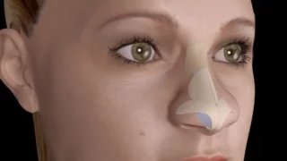 Bulbous Large Nasal Tip Nose Job Rhinoplasty