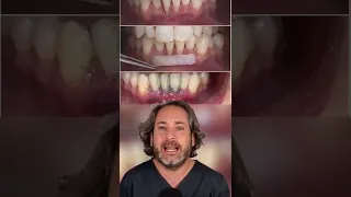 SOLUCIÓN a la SENSIBILIDAD después de una LIMPIEZA dental - FIN a los dientes destemplados