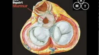 Animated Aortic Stenosis Murmur