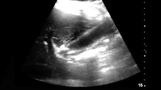 SonoSim Ultrasound Video Challenge - Intestinal/Biliary