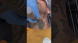 Removendo tatuagem no pescoço | Remoção de Tatuagem