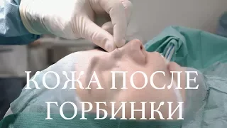 Кожа после горбинки // Ринопластика