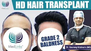 Ultra - High Density Hair Transplant Results | Grade 2 Baldness | Maximum Density by Hair Transplant