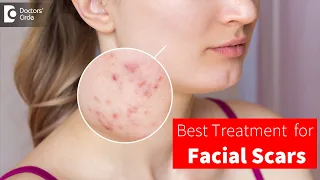 GET RID OF FACIAL SCARS |  Best Treatment Plan by DERMATOLOGIST -Dr.Rajdeep Mysore | Doctors' Circle