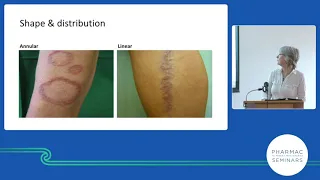 PHARMAC seminar: Dermatology update, acute rashes part 1