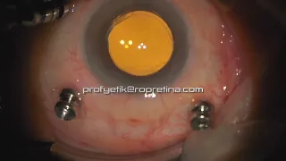 Vitreomacular Traction Vitrectomy Surgery