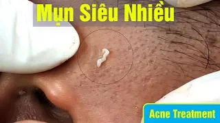 Cách điều trị mụn ẩn lâu năm hiệu quả uy tín. Tại Hiền Vân Spa - bài 220