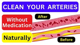 Top 10 Foods to Clean Your Arteries that Can Prevent a Heart Attack | Goodlifeguru