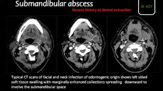 Imaging of head and neck infection I  Prof Dr  Mamdouh Mahfouz In Arabic