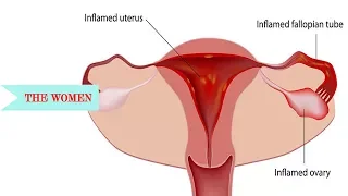 Menstrual Cramps and Painful Periods|| Common Gyn Problems