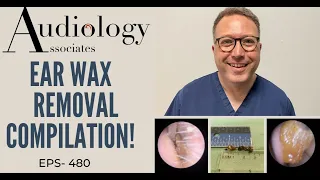 EAR WAX REMOVAL COMPILATION - EP480