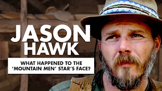 What happened to 'Mountain Men' Jason Hawk face?