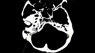 Venus Sinus Thrombosis and Intraventricular haemorrhage - CT, CT angiogram and Venogram