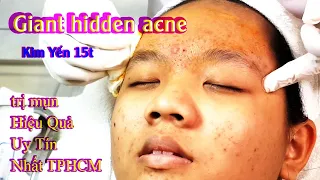 Cách Điều Trị Mụn Tuổi Dậy Thì Hiệu Quả Nhất TPHCM Tại Hiền Vân Spa _Đồng _Kim_Yến-15t I Bài 318