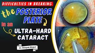 Difficulties in breaking posterior plate in an ultra hard cataract (Tips) - Dr. Deepak Megur