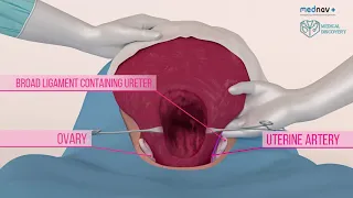 How to perform a caesarean section and deliver babies in different positions at caesarean section