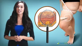 Myths and Facts about Cellulite You Need to Know