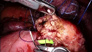 Pancreatic anastomosis