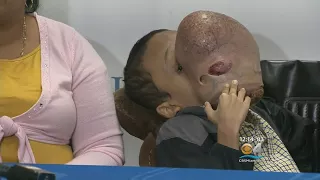 UM Health Doctors To Remove 10 Pound Tumor From Teen's Face