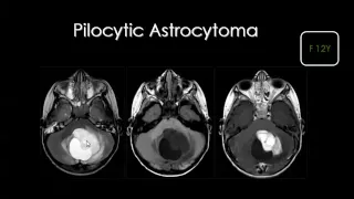 Imaging of Pediatric brain tumor   Prof Dr  Mamdouh Mahfouz In Arabic