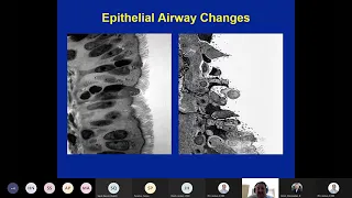 Asthma Pathogenesis (Rosenwasser)